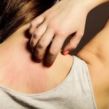 რა არის ურტიკარია. (ჭინჭრის ციება)